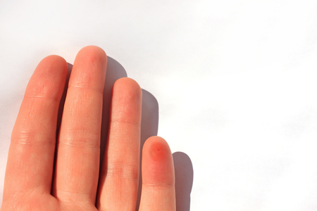 A finger stung by a bee. Female hand with an insect bite, isolated on white background, copy space.の写真素材