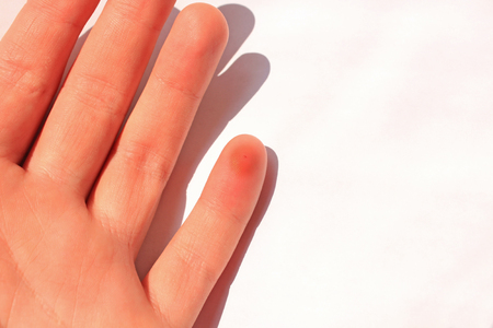A finger stung by a bee. Female hand with an insect bite, isolated on white background.の写真素材