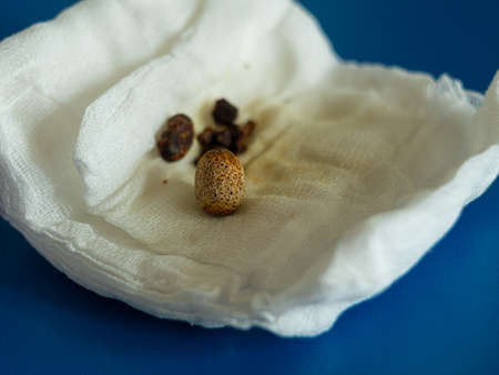 Removed gallstones on compress after gallbladder laparoscopic surgery endoscopy removing. Cholecystectomy on abdomen Liver dysfunction icteruswith bilirubin biliary tract obstruction precipitated bileの写真素材