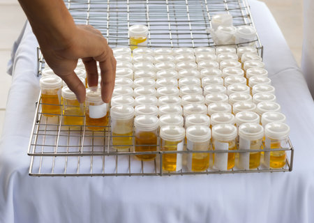 Urine of patients and of common people. Check the analysis.
To detect a disease in the body. Take...