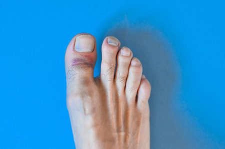 Damaged big toe on a blue background.