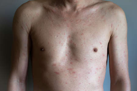 Atopic eczema allergy texture of ill human skin. Man with symptoms of itchy urticaria.の写真素材
