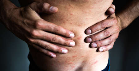 An adult infected Varicella virus and itchy red blisters that appear all over the body with feverの写真素材