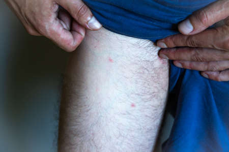 A rash on a man's leg near the intimate area. Man with symptoms of itchy urticariaの写真素材