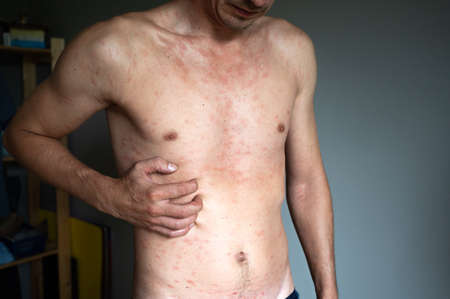 An adult infected Varicella virus and itchy red blisters that appear all over the body with fever.の写真素材