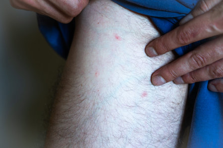A rash on a mans leg near the intimate area. Man with symptoms of itchy urticaria.