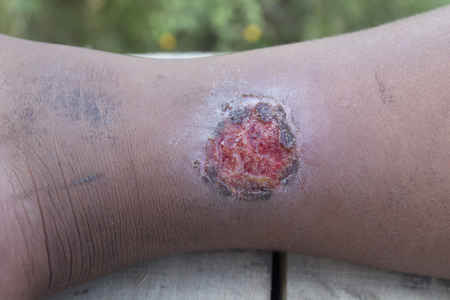 Infected wound on leg.の写真素材