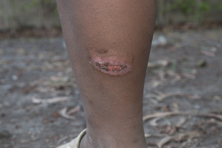 Infected wound on leg.の写真素材