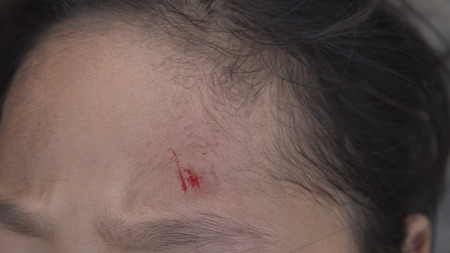 Wound infection on faceの写真素材