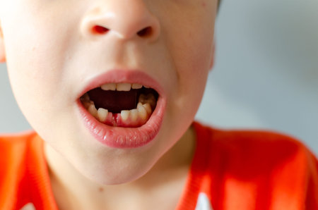 Boy's mouth close-up, tooth hole bleeds, milk tooth fell out. Growing child concept.の写真素材