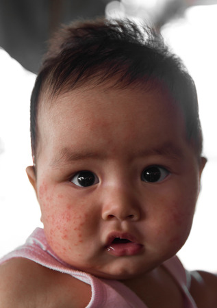 Close-up face baby rashes, dermatitis, which is full of it, but still good.の写真素材
