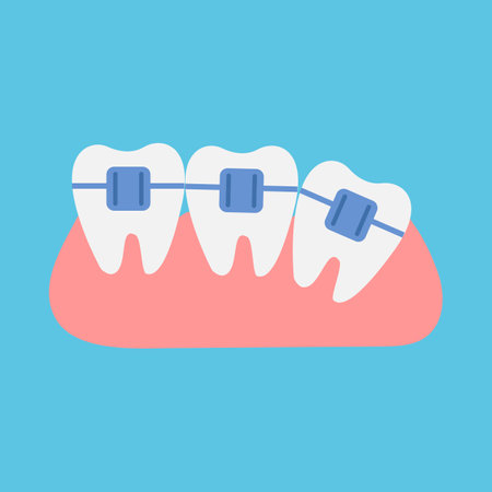 Teeth with braces on a blue background. Flat style. Vector.のイラスト素材