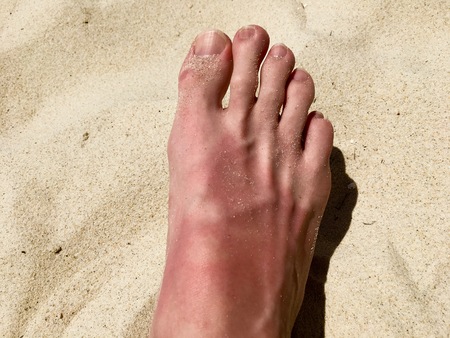 White man skin foot turned sunburnt red on sandの写真素材