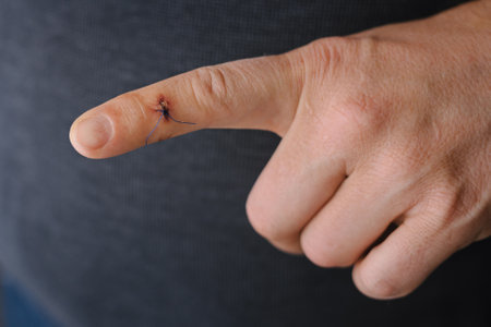 Inspection of seam on finger after removal of dermatofibroma. Surgeryの写真素材