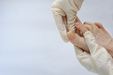 Onychomycosis. Feet with fungus on nails are examined by podiatrist in glovesの写真素材