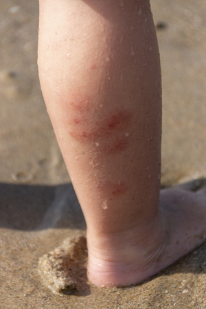 a close up view of Mosquito bits or skin rash on a small childs leg that are healingの写真素材