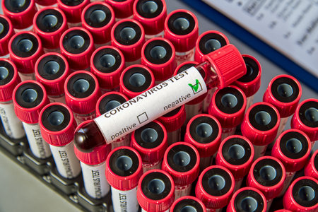 Test tube with negative blood test for COVID-19 on vacuum tubes with blood samples. Blood test for the presence of antibodies to the causative agent of a new coronavirus infection.の写真素材