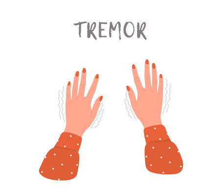 Tremor hands. Parkinson disease. Female arms with nails. Physiological stress symptoms. Vector illustration in flat cartoon styleのイラスト素材
