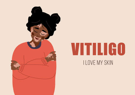 African woman with vitiligo. Self care and self love. World vitiligo day. Skin disease. Vector illustration in flat cartoon styleのイラスト素材