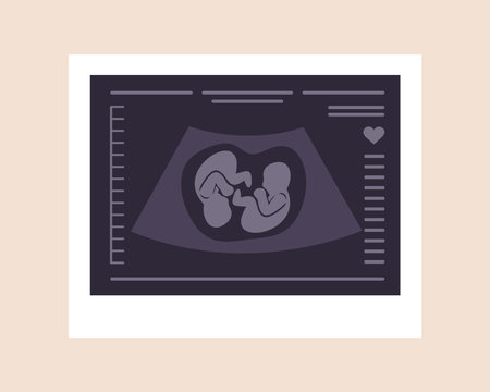 Ultrasound of twins. Embryos in womb. Pregnancy screening. Babies health diagnostic. Fetus silhouettes photo. Sonography or ultrasonography concept. Vector illustration in flat cartoon styleのイラスト素材