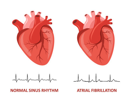 Heart diseases. Normal sinus rhythm and Atrial fibrillation. Medical check up. Vector illustration in flat cartoon styleのイラスト素材