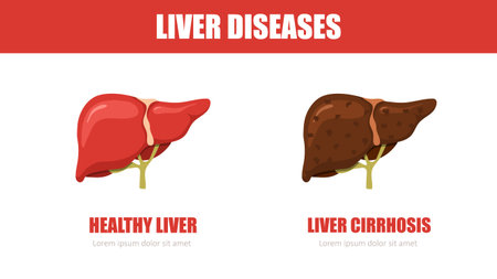 Liver disease. Healthy and cirrhosis liver. Internal organ icons. Medical illustration. Vector designのイラスト素材