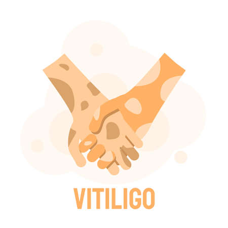 Flat Human Hands With Spots Vitiligo Depigmentation Disease Vector Design Style Concept People Are Equalのイラスト素材