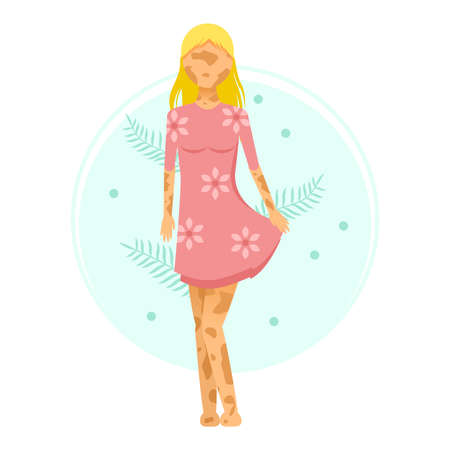 Flat Girl Woman Character In Dress Vitiligo Depigmentation Disease Vector Design Style Concept People Are Equalのイラスト素材