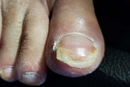 Close up of a toenail needs a pedicure