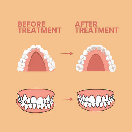 Teeth Before and After Treatment Vector Icon Illustration. Teeth Before and After Braces Vector. Flat Cartoon Style Suitable for Web Landing Page, Banner, Flyer, Sticker, Wallpaper, Backgroundのイラスト素材