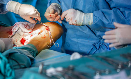 Process of varicose vein surgery in a hospital, operating roomの写真素材