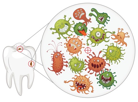 Caries. Funny bacteria and tooth. Vector illustration. Isolated on white backgroundのイラスト素材