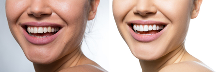 Laughing woman mouth with great teeth over white background. Healthy beautiful female smile. Teeth health, whitening, prosthetics and care.の写真素材