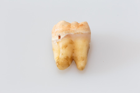 Unhealthy dirty toothの写真素材