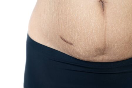 Fat belly scratch mark pregnancy female Skin surgical operation remove appendix scar