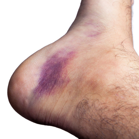 Bruised ankle after tripping over and twisting on right hairy foot isolated on white background.の写真素材