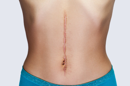Closeup of young woman with large scar after surgery on abdomen. medical treatment and scars removal concept. indoor studio shot, isolated on grey background.の写真素材
