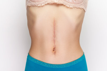 Closeup portrait of young woman with large scar after surgery on abdomen, naked belly with scar after cesarean. Indoor studio shot isolated on gray background.の写真素材