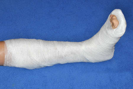 Broken human leg in cast