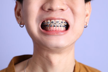 The Adult east Asian man with braces standing on the blue background.の写真素材