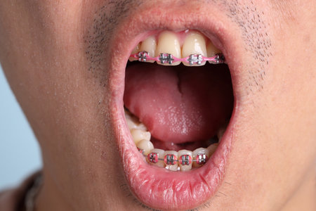 Close-up of asian man with braces, wearing a casual t-shirt, gesture of smiling on blue background.の写真素材
