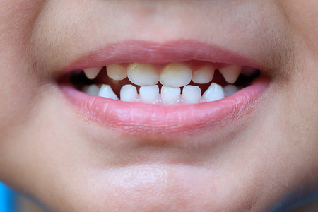 The baby's mouth with a milk tooth