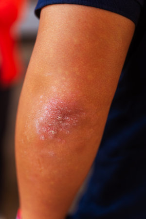 Detailed CloseUp Examination of a Skin Condition Present on an Individuals Armの写真素材
