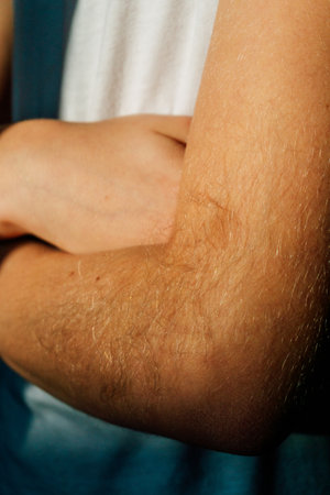 the student has very hairy hands. the problem with the abundant growth of hair in the childs arms