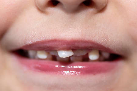Little boy with open mouth showing milk teeth in front and growing permanent teeth.の写真素材