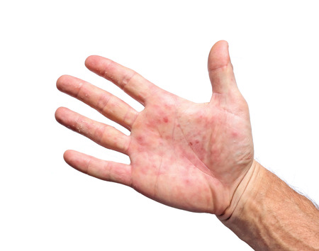 Palm patient erythema in red in ulcers from inflammation isolated on white background