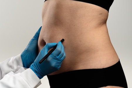 Preparing for Cosmetic Surgery with Markings on Abdomenの写真素材