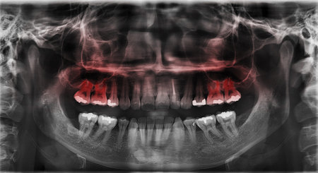 Panoramic dental x-ray of teeth and mouth with red spot for pain area- black and white colorの写真素材