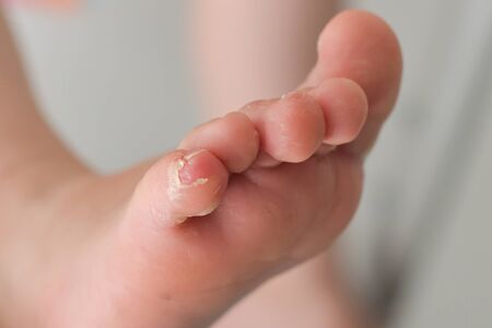Enterovirus foot hand mouth Skin peeled off on the body of a child Cocksackie virusの写真素材