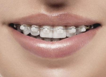 Braces teeth mouth orthodontics woman. Close up studio shot.